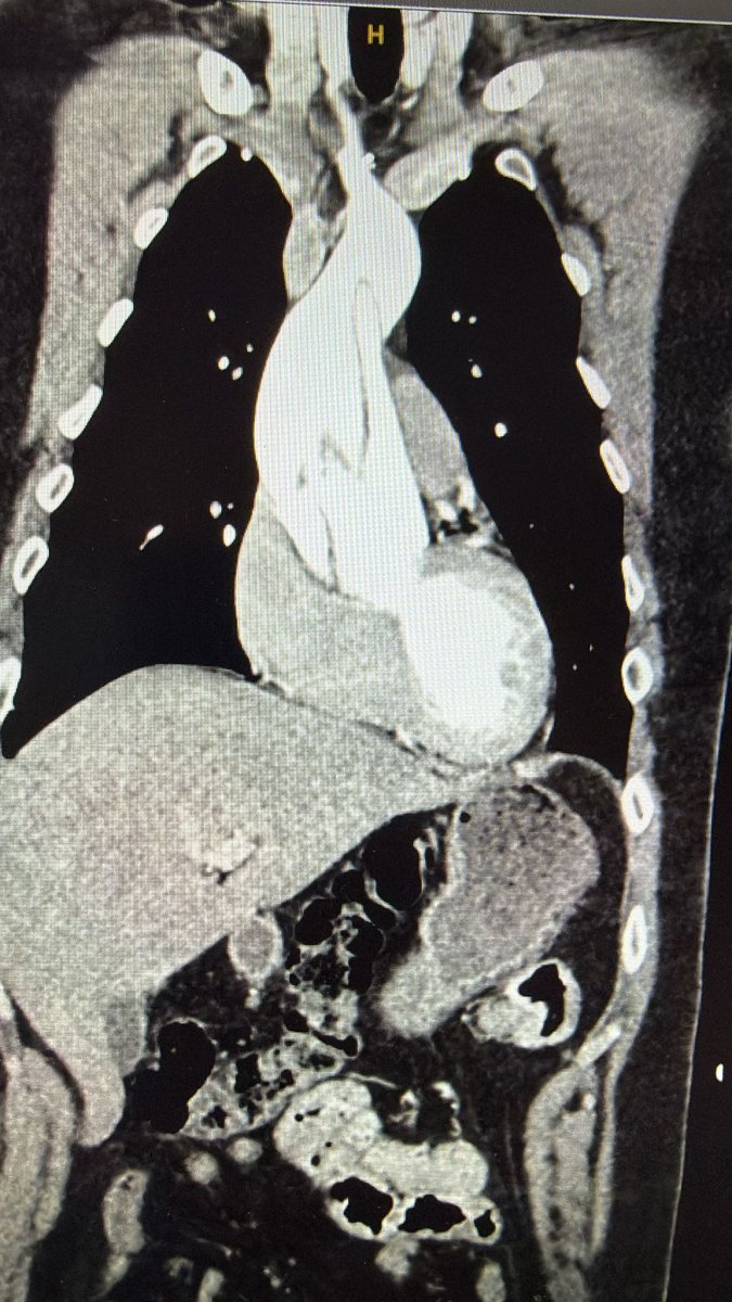 צילום הדמיה ובו הקרע באבי העורקים של א', קרדיט צילום: שערי צדק.