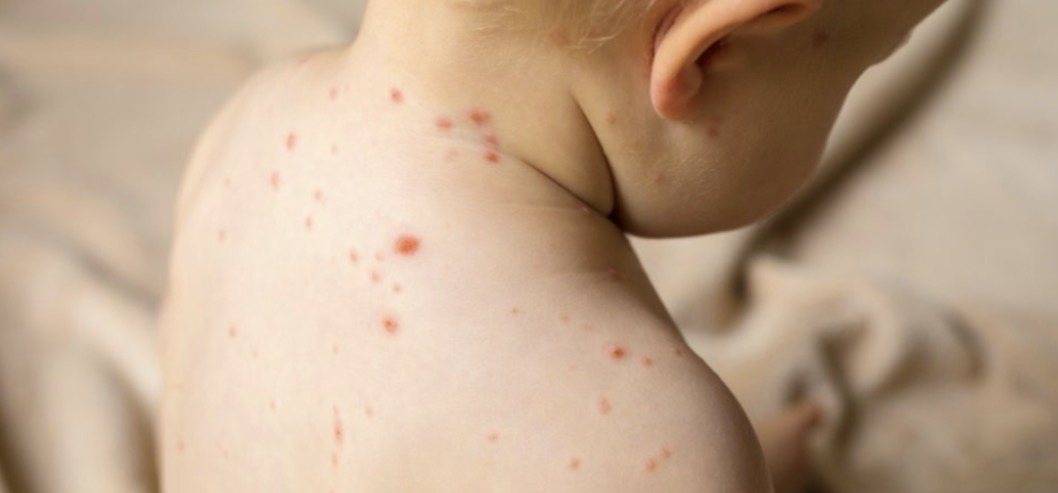 חצבת. אילוסטרציה 