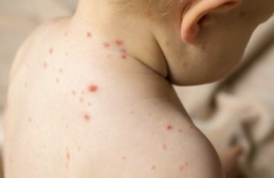 חצבת. אילוסטרציה 